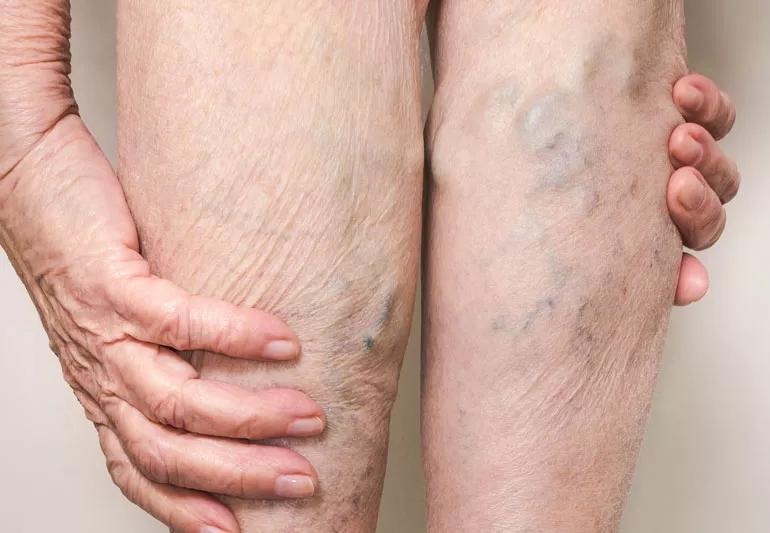 Understanding Vein Health: What Causes a Vein to Collapse